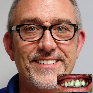 A man that had our six month smiles clear braces in Greenwood, IN
