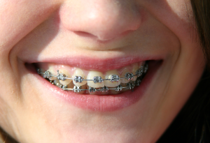 Straight Talk About Braces for Adults