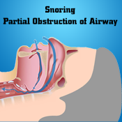 osa-airway-diagram-snoring-partial-obstruction